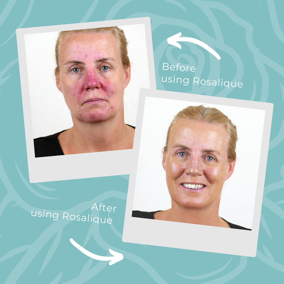 3in1 Anti-Redness SPF50 | Wegański krem z filtrem maskujący zaczerwienienia skóry twarzy 30ml